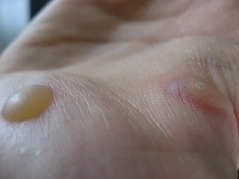 how to prevent blisters when running